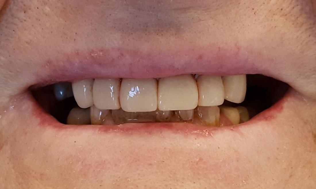 Cosmetic Bonding For Worn Teeth Colorado Springs CO Dentistry