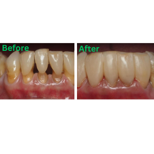 bioclear colorado springs | black teeth triangles before and after