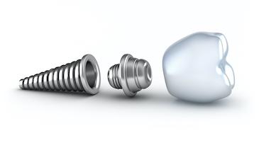 An illustration of a dental implant on a crown at springs family dental