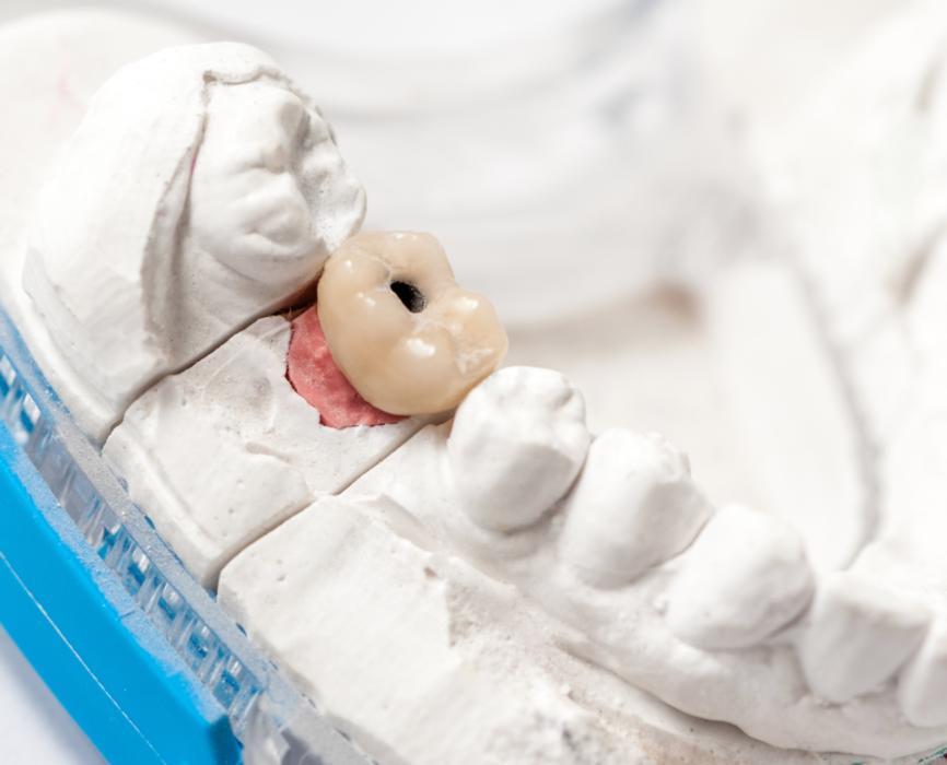 fillings in colorado springs 