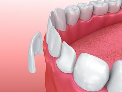 Illustration of dental crown with veneer floating in front of it in Colorado Springs