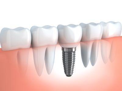 Illustration of dental implants in Colorado Springs
