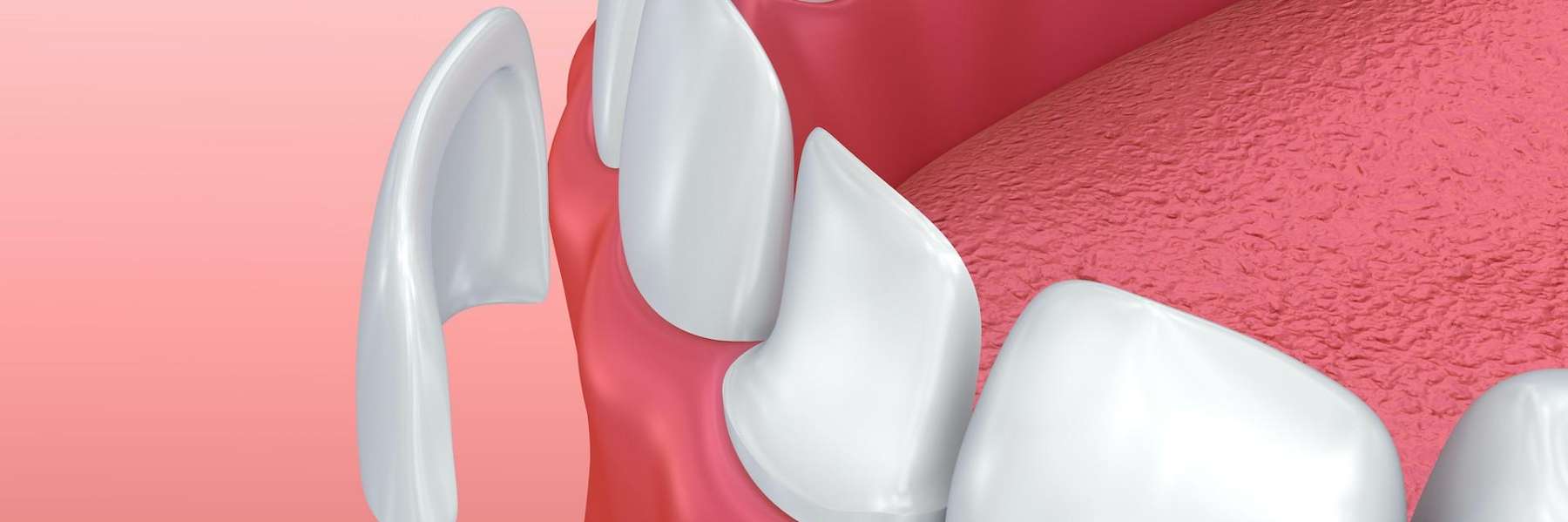 Dental Veneers in Colorado Springs, CO