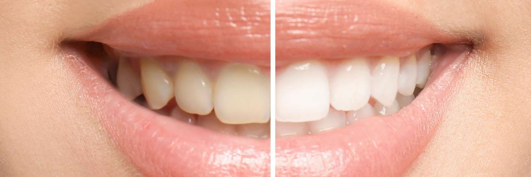 Photo of patient's teeth before and after whitening at Springs Family Dental