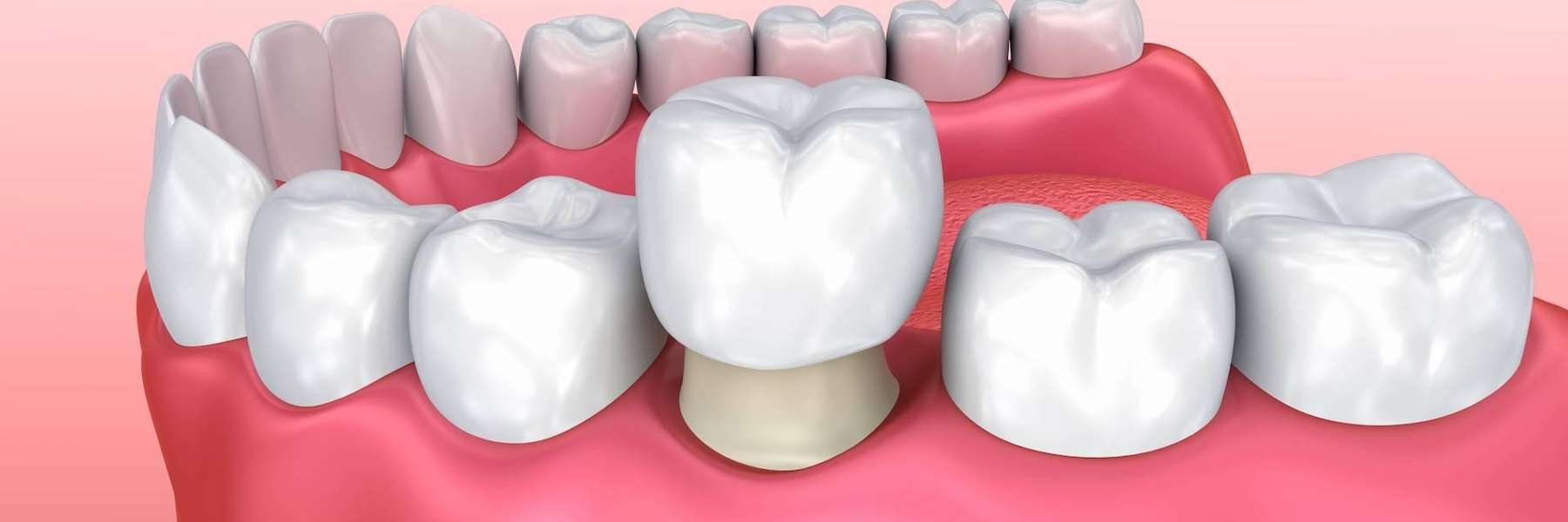 An Illustration of a Dental Crown at Springs Family Dental