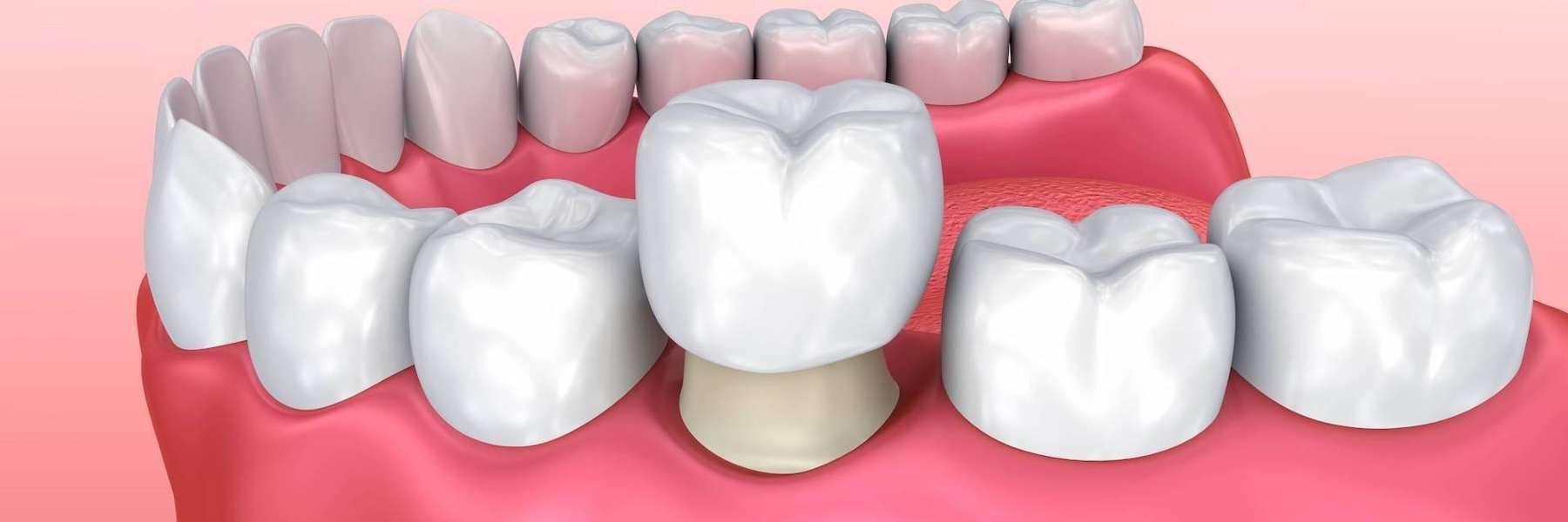 An illustration of a Dental Crown in Colorado Springs