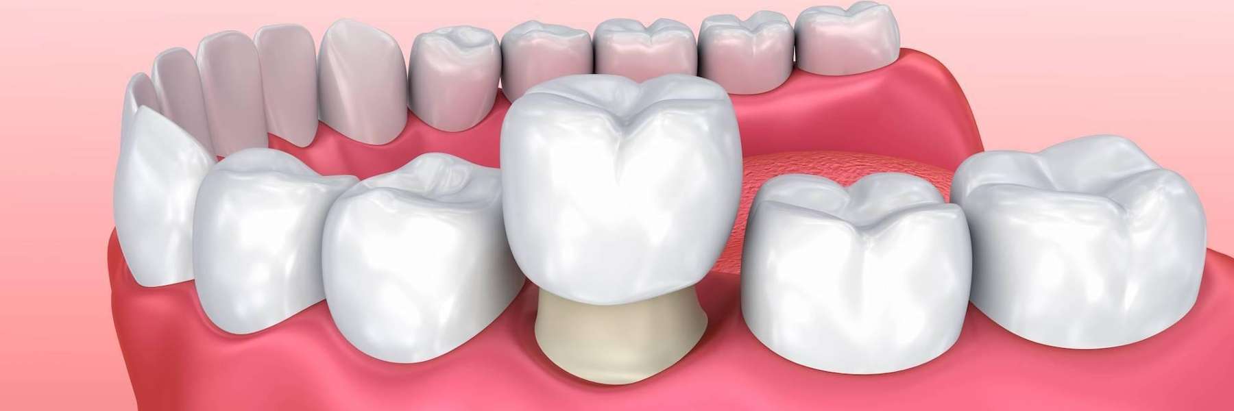 An Illustration of a Dental Crown in Colorado Springs