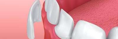 An illustration of dental crown and a hanging veneer at Springs Family Dental