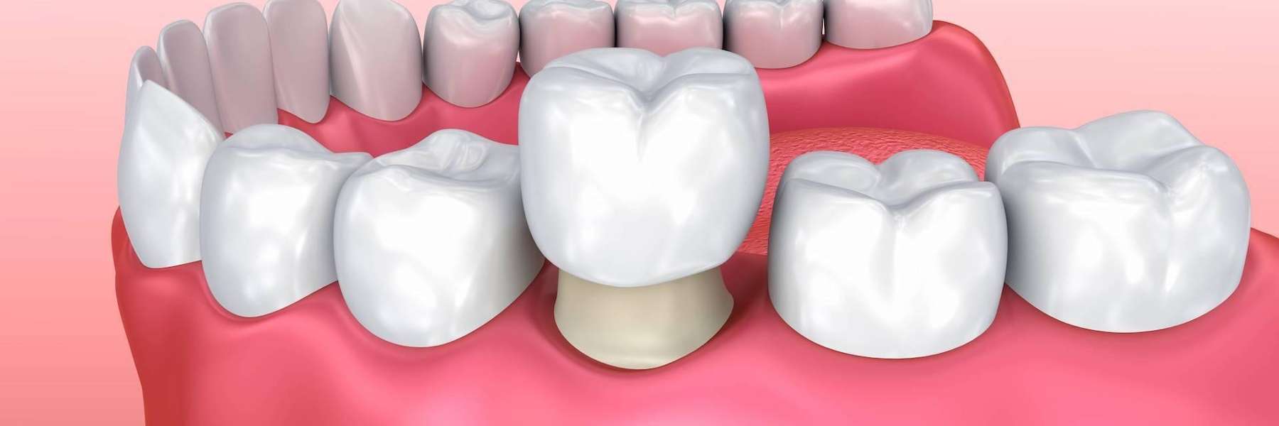 An Illustration of a Dental Crown in Colorado Springs