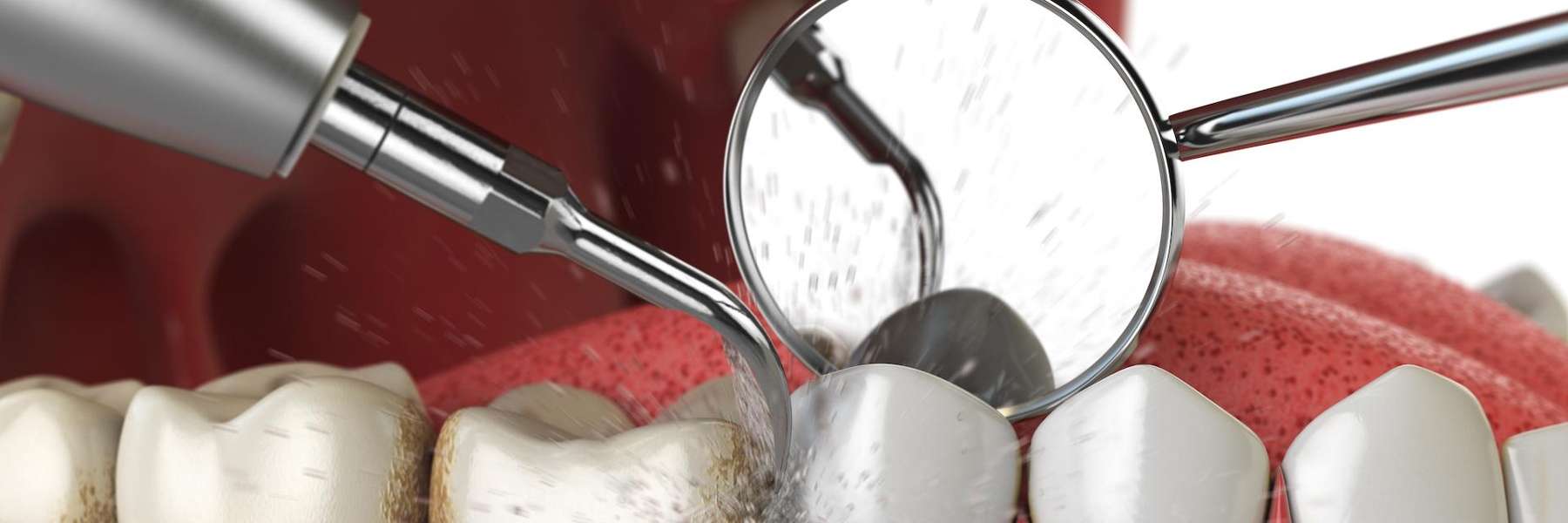 a dental cleaning in Colorado Springs, CO