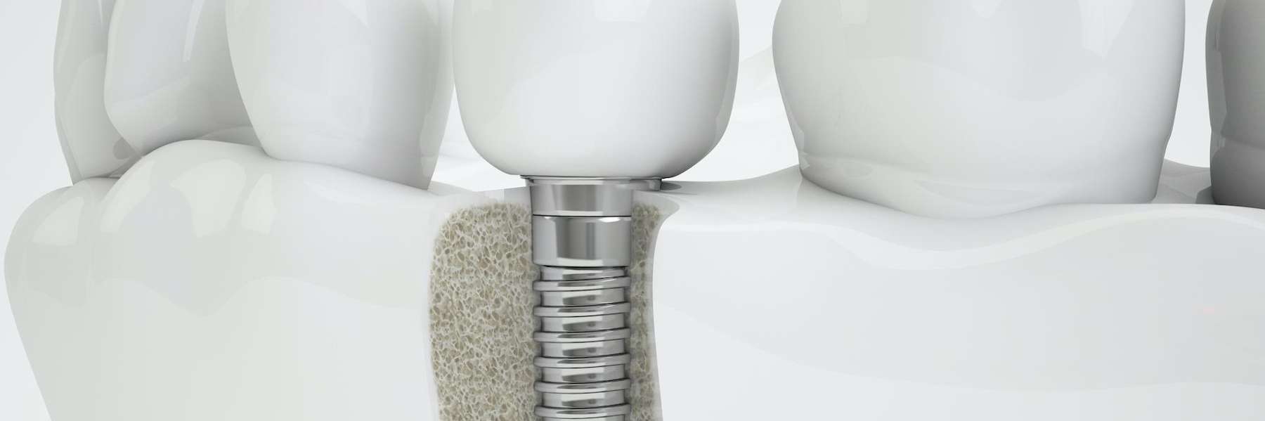 An illustration of Dental Implants in Colorado Springs, CO