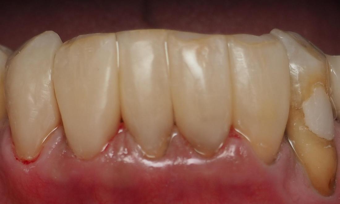 bioclear treatment | cosmetic dentist colorado springs