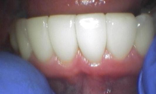 Bioclear after