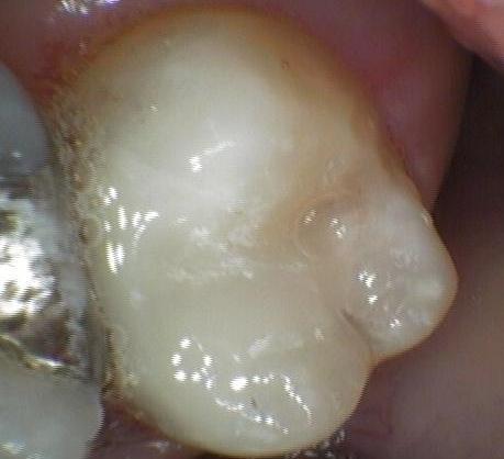molar tooth with dental bonding