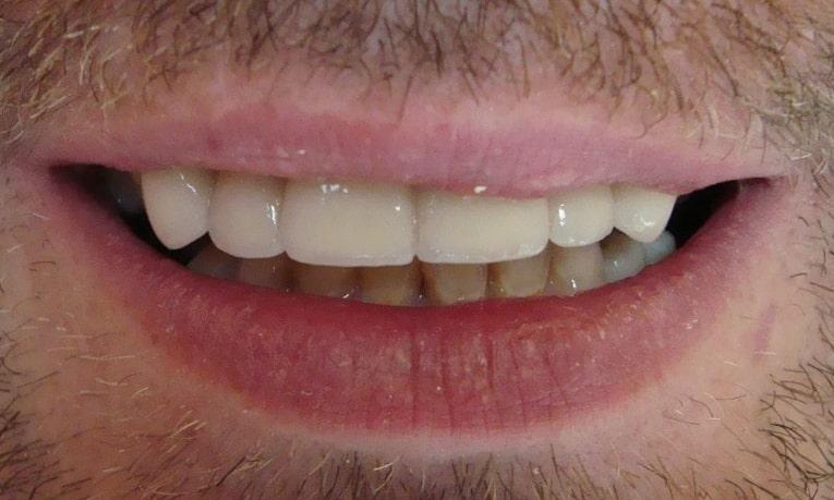 Cosmetic Ceramic Crowns | cosmetic dentist colorado springs