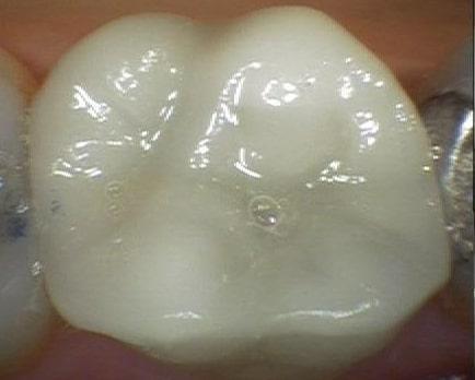 molar tooth with natural filling