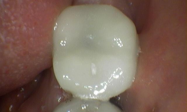 Worn Down And Decayed Molar Cured With A Composite Crown | cosmetic dentist colorado springs