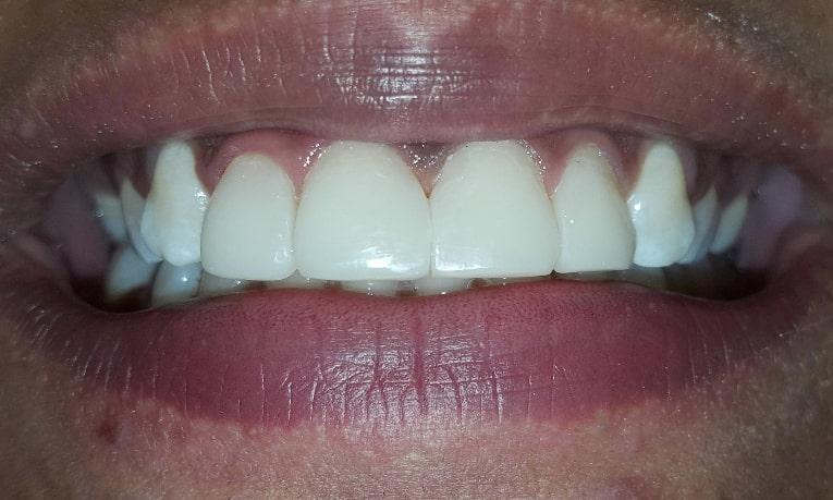 teeth with dental bonding