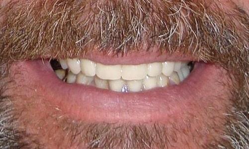 Partial Dentures To Cover Up Missing Areas In The Mouth | cosmetic dentist colorado springs