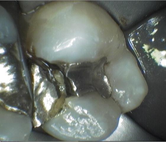 broken metal filling on molar