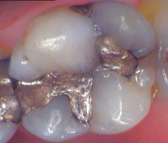broken tooth with metal filling