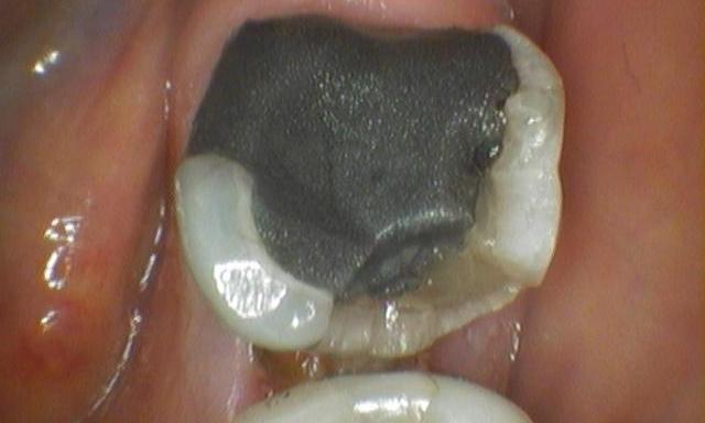 Worn Down And Decayed Molar | Before | cosmetic dentist colorado springs