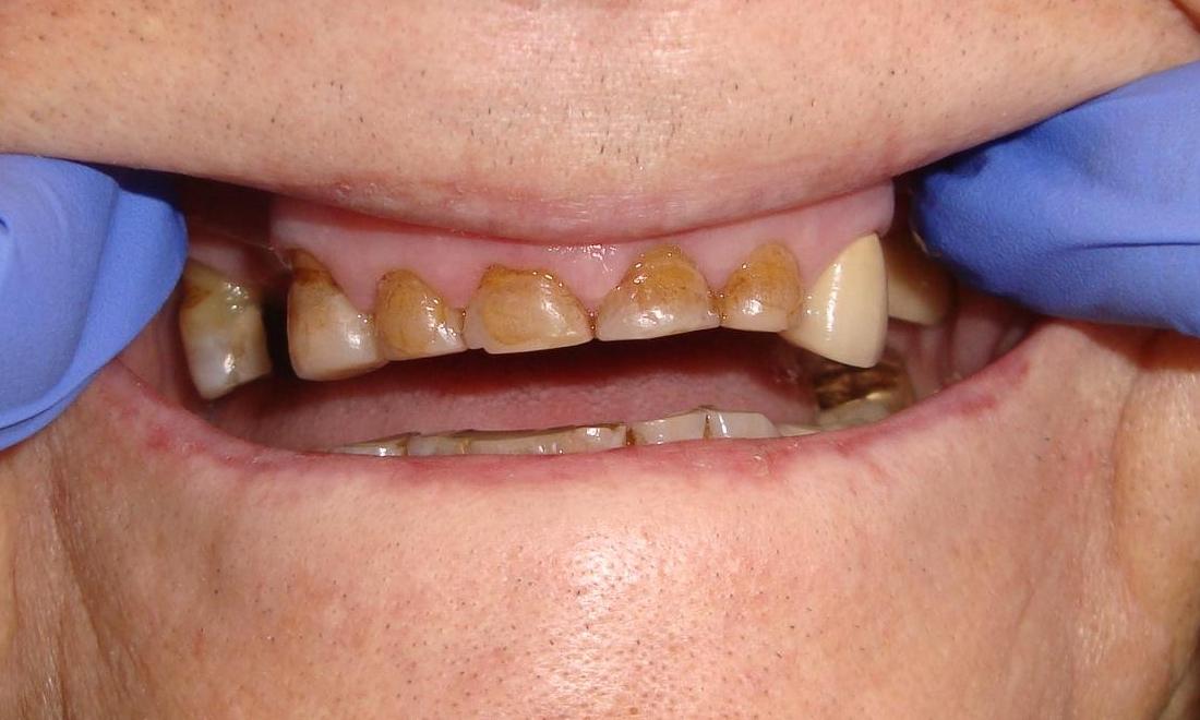 worn upper teeth