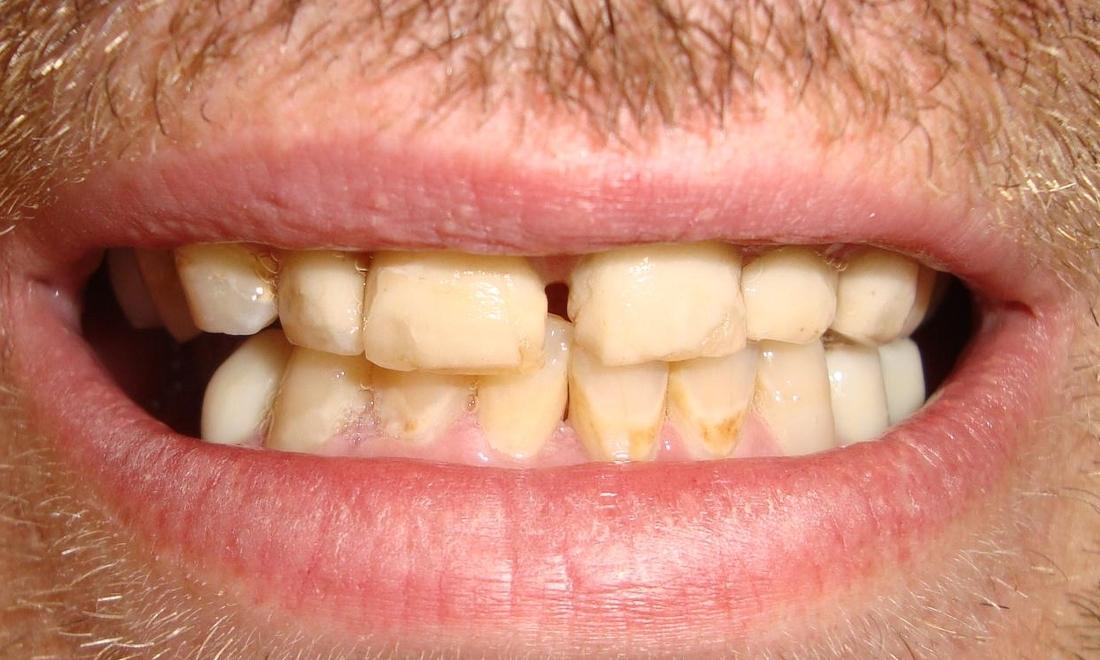 Stained, crooked teeth | cosmetic dentist colorado springs 