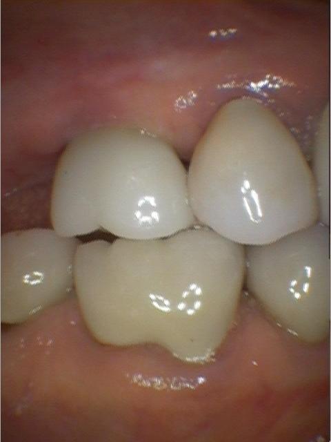 Crooked, crowded teeth before | dental implants colorado springs