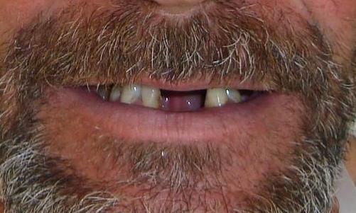 Multiple Missing Teeth In The Mouth | Springs Family Dental | cosmetic dentist colorado springs