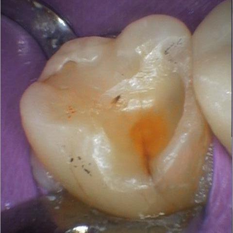 Molar Tooth That Broke From Grinding | cosmetic dentist colorado springs