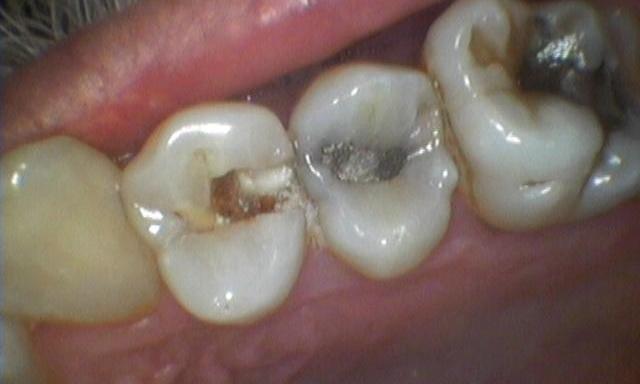 Decayed and fractured tooth | Colorado Springs, CO