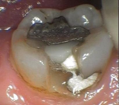 Fractured Molar Tooth With Amalgam Filling | cosmetic dentist colorado springs