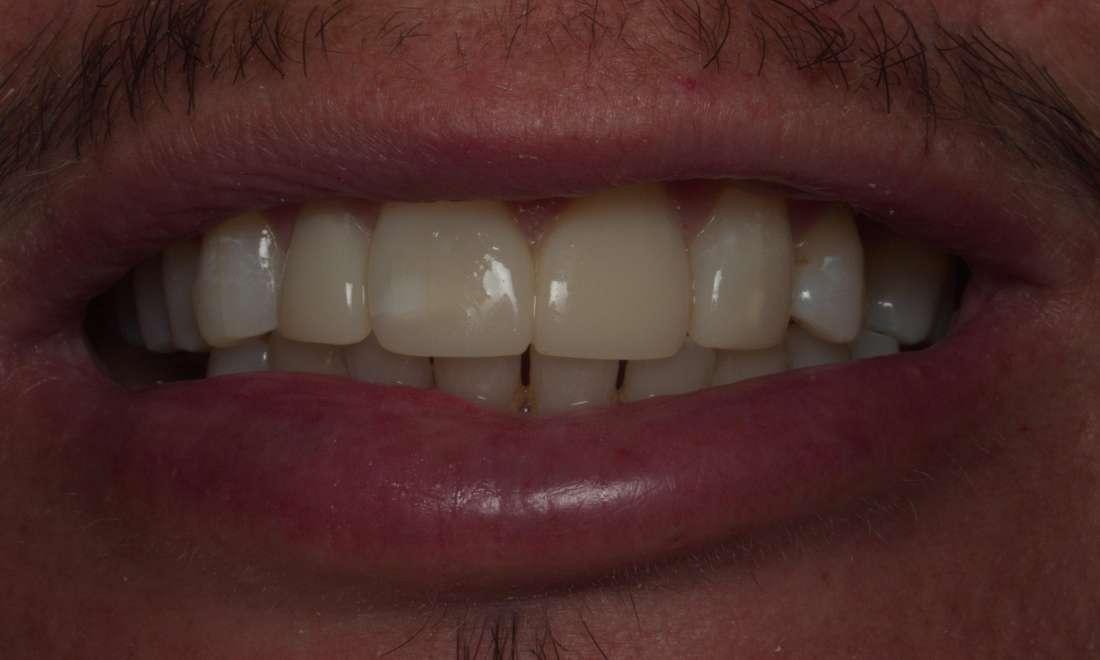 Bioclear Bonding After Photo