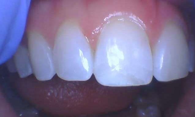 Chipped Front Tooth After 