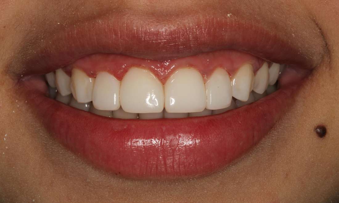 Patient's teeth after dental bonding in Colorado Springs, CO 