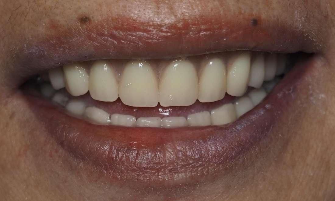 After denture completed 