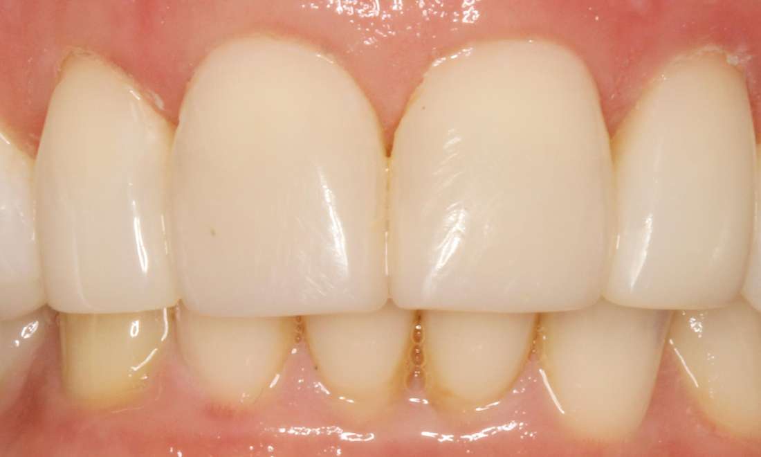 an after photo of Cosmetic Bonding at Springs Family Dental