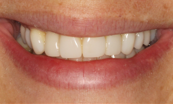 Colorado Springs Smile Makeover- After photo