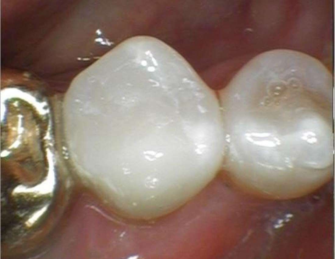 Colorado Springs Fillings- After