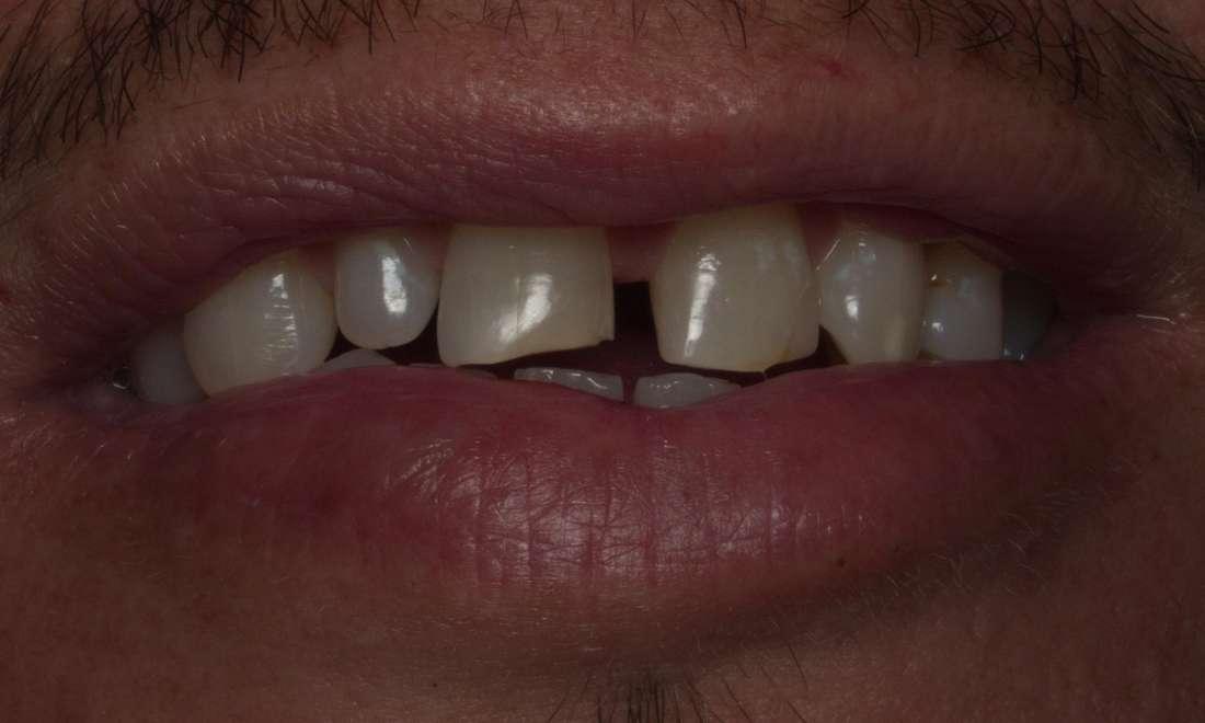 Bioclear Bonding Before Photo