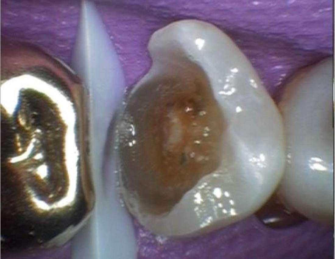 Colorado Springs Fillings- Before