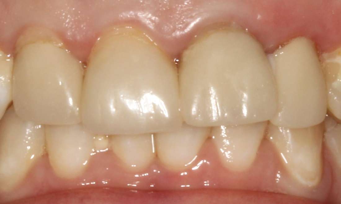 A before photo of a Ceramic Crowns
