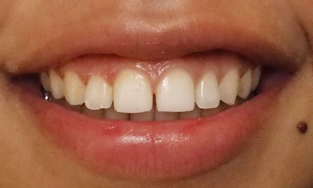 Patient's teeth before dental bonding in Colorado Springs, CO 
