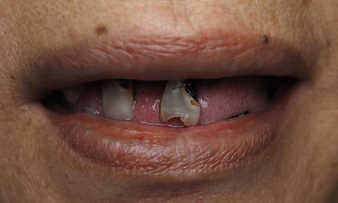 Before denture with broken down teeth