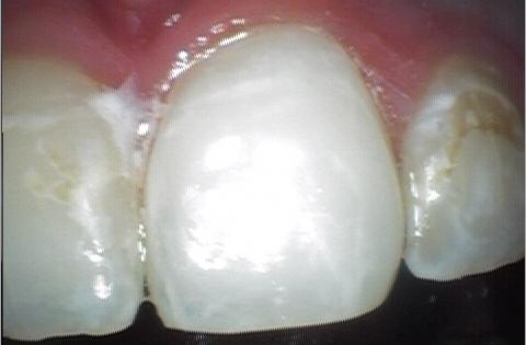 Cosmetic-Bonding-to-repair-enamel-After-Image