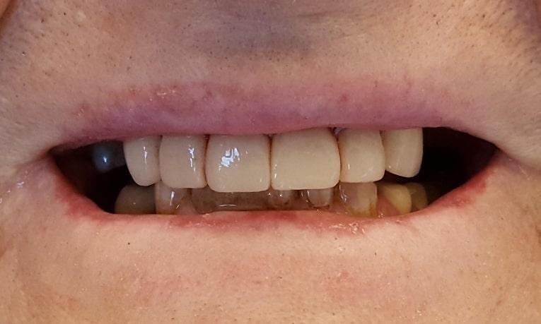 dental bonding upper teeth