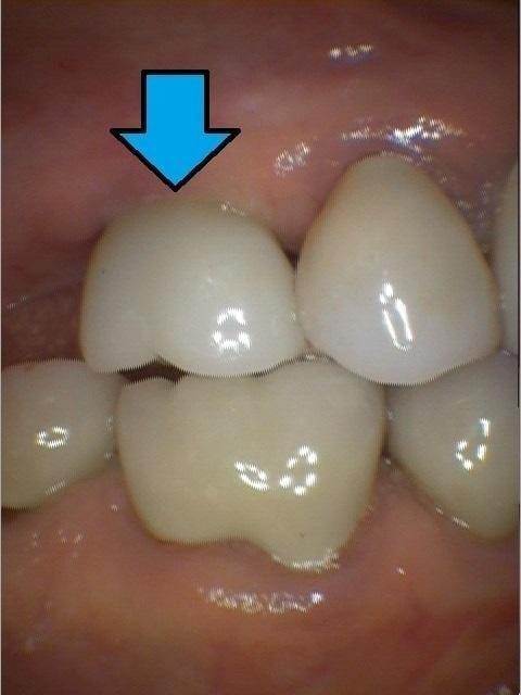 Dental-implants-look-and-function-like-natural-teeth-After-Image