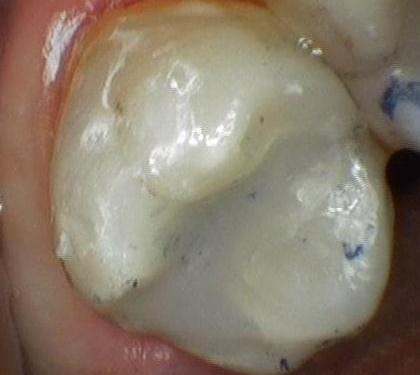 Tooth Colored Filling On Molar Tooth | cosmetic dentist colorado springs