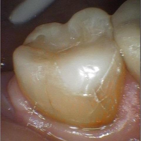 Tooth With Composite Filling To Fix It | cosmetic dentist colorado springs